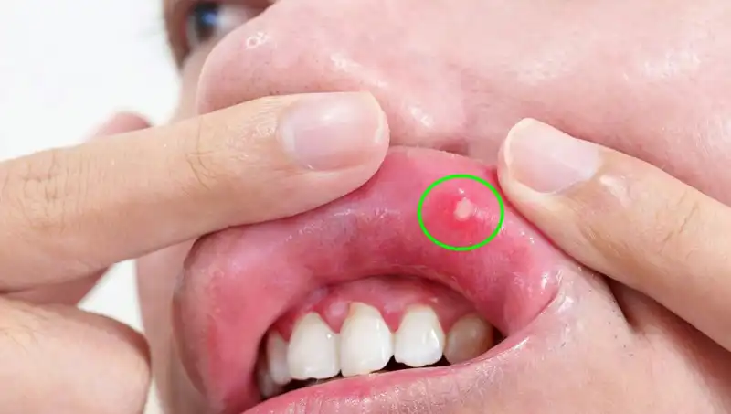 Kanserin Sinsi Belirtileri: Dili Alınan Adamın Hikayesi